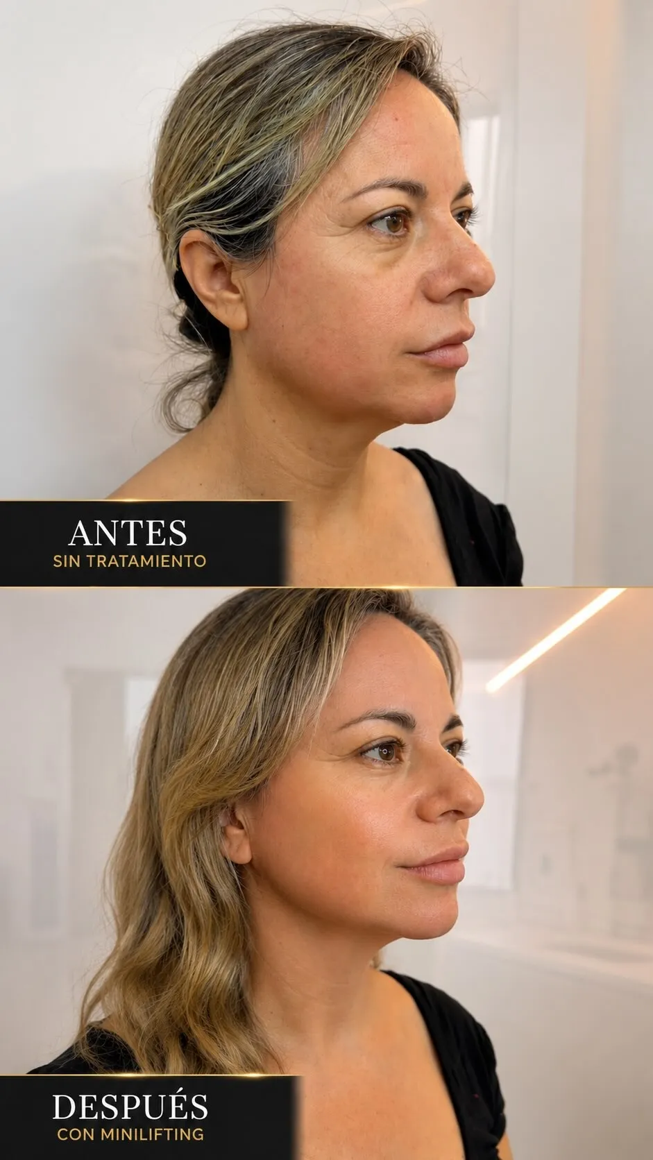 Caso individual de Mini Lifting cervical: perfil de una paciente sin tratamiento y después.